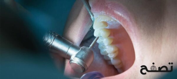 علاج عصب الأسنان عند الطبيب