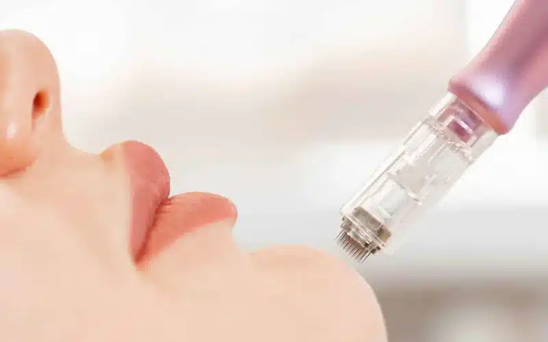 هل يعزز Calecim Professional نتائج علاج Microneedling؟